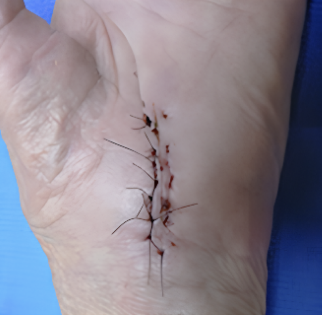 The alternative open carpal tunnel procedure
