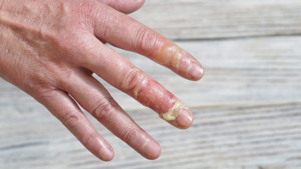 types of finger injuries